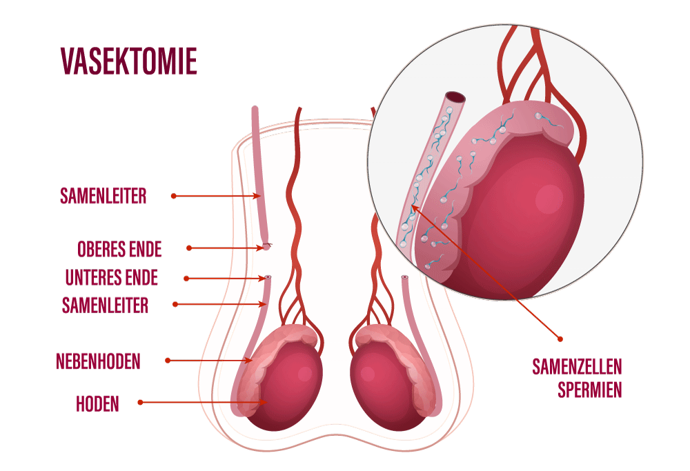 Visuelle Darstellung einer Vasektomie